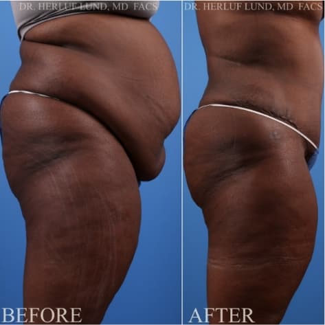 Body procedure before and after