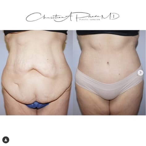 Before and After Tummy Tuck by Dr. Prada