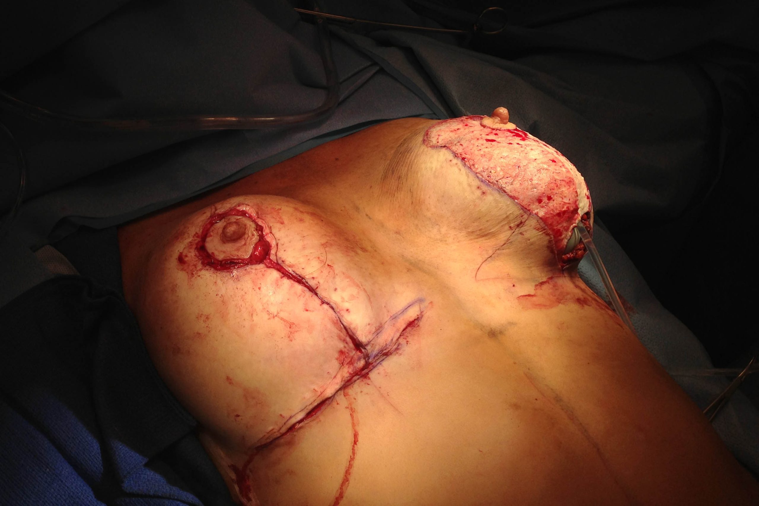 Breast Lift Anchor Incision