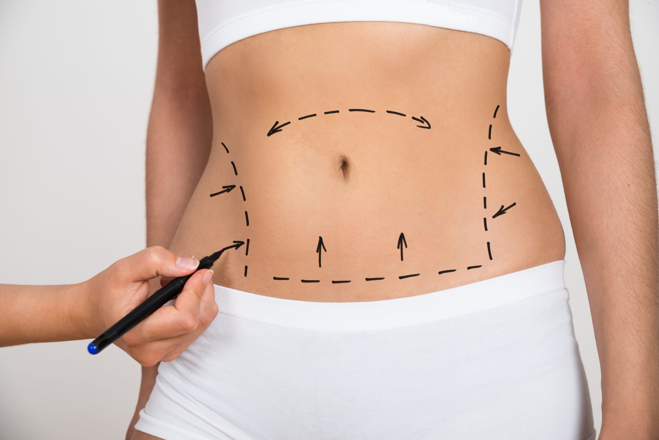Person Hand Drawing Lines On A Woman's Abdomen As Marks For Abdominal Tummy Tuck