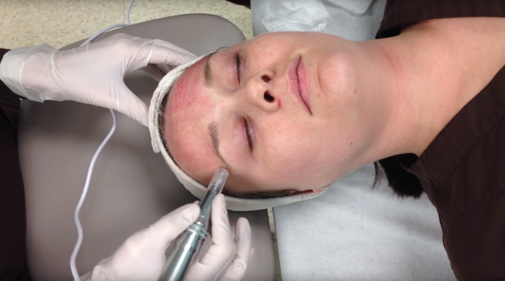 Woman getting microneedling treatment at St. Louis Cosmetic Surgery.