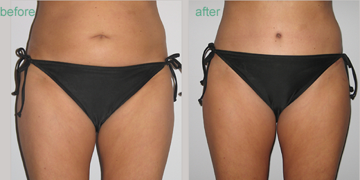 Learn more about liposcuction at our St. Louis plastic surgery practice