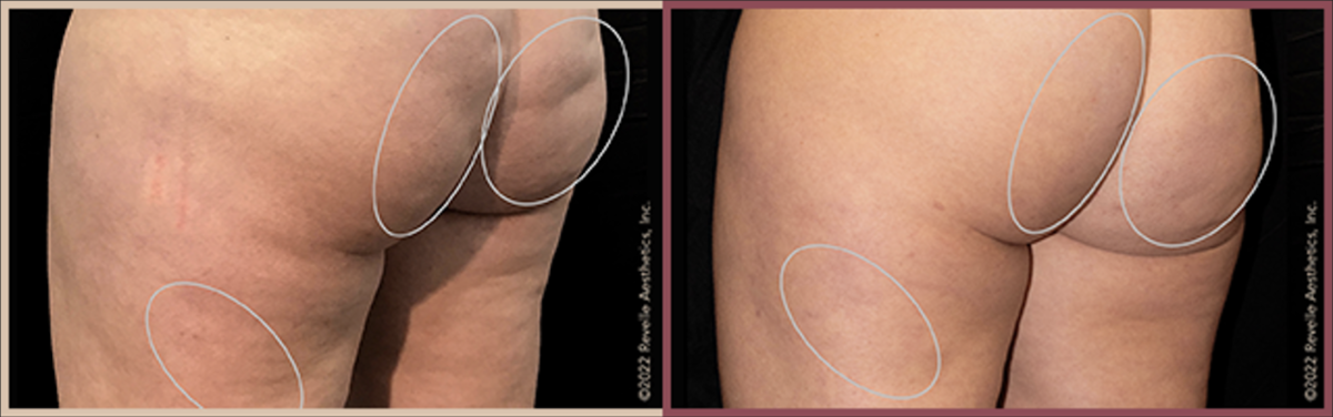Buttocks before and after Aveli treatment