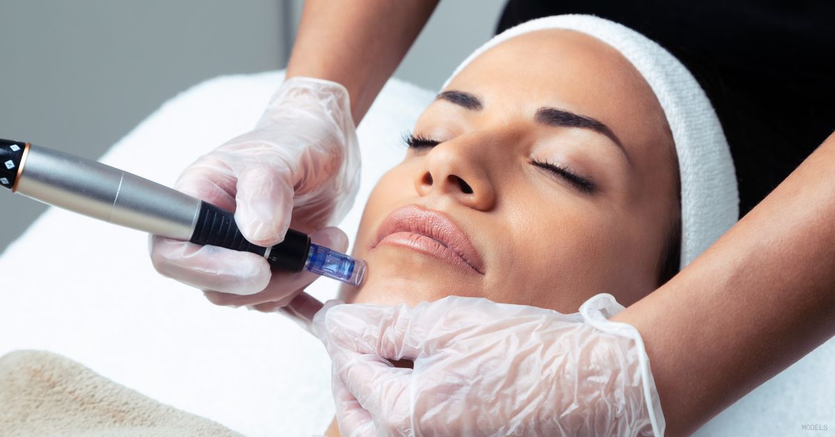 A woman receiving a microneedling treatment. (Models)