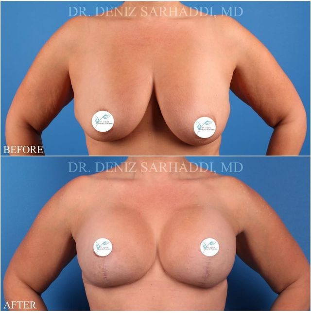 This gorgeous 42 year old had a #breastlift and #breastaugmentation using #siliconebreastimplants and  W🤩W

Dr. Sarhaddi performed this breast lift with augmentation at the same time with a little #liposuction of her ‘side boob’ to really frame the breasts on her chest.

405cc smooth, moderate projection implants were used to achieve this look!

Notice all her breast tissue is lifted off her abdomen, to give her a longer looking torso.

Call 📱 636-530-6161 or #linkinbio to book your breast augmentation consultation with Dr. Deniz Sarhaddi today!

#braless
#femaleplasticsurgeon
#mastopexyaugmentation #mastopexy
#breastimplants #perkybreasts #stlcosmeticsurgery #plasticsurgery