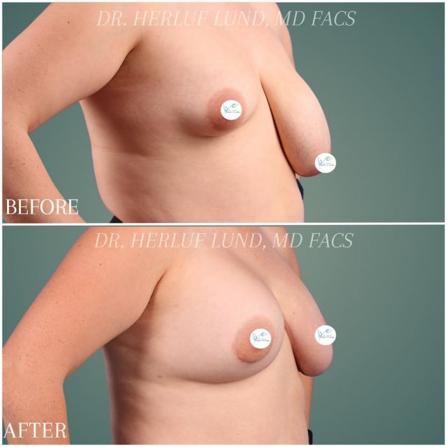 This 27yo is shown 1 yr postop from a remarkable augmentation by Dr. Herluf Lund. 

🌟She has lived with significant asymmetry and grade three ptosis of the left breast- which is characterized by an inferior descent of the nipple relative to the breast fold with lower pole skin redundancy. This excessive imbalance has greatly impacted her life for many years.

🌟Initial measurements indicate an A cup size in the right breast and triple D cup in left breast

🌟Dr. Lund performed a left breast reduction using inferior pedicle technique and matched with a right breast augmentation utilizing a natrelle inspira cohesive 415cc implant to achieve balance. 

🌟The patient is doing beautifully, can now comfortably wear swimsuits, source bras and feel more confident with her life changing results! 

We are so happy for this patient!
 
Call 📱636-530-6161 or use #linkinbio to book your consultation with Dr. Herluf Lund today
 
📍 17300 N Outer 40 Road
Chesterfield, MO 63005
📧info@stlcosmeticsurgery.com
@herlundlundmd