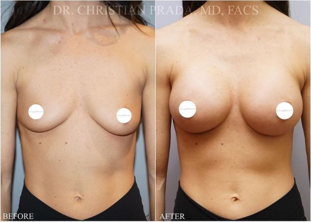 🌟 This 31 year old patient is just over one month out from her Breast Augmentation surgery with Dr. Christian Prada

Implant size: (Cohesive Gel)
Left- 345cc
Right- 365cc

Call 📱 636-530-6161 to book your consultation with Dr. Christian Prada today!

📍 17300 N Outer 40 Road
Chesterfield, MO 63005
📧 info@stlcosmeticsurgery.com

#bodybyprada #stlcosmeticsurgery 
#breastaugmentationbeforeandafter #cosmeticsurgery #plasticsurgery